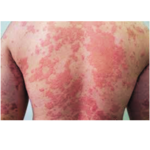 This image shows a person suffering from the skin disease psoriasis who will be normal after the best homeopathic treatment