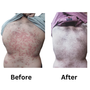 Best homeopathic treatment for psoriasis