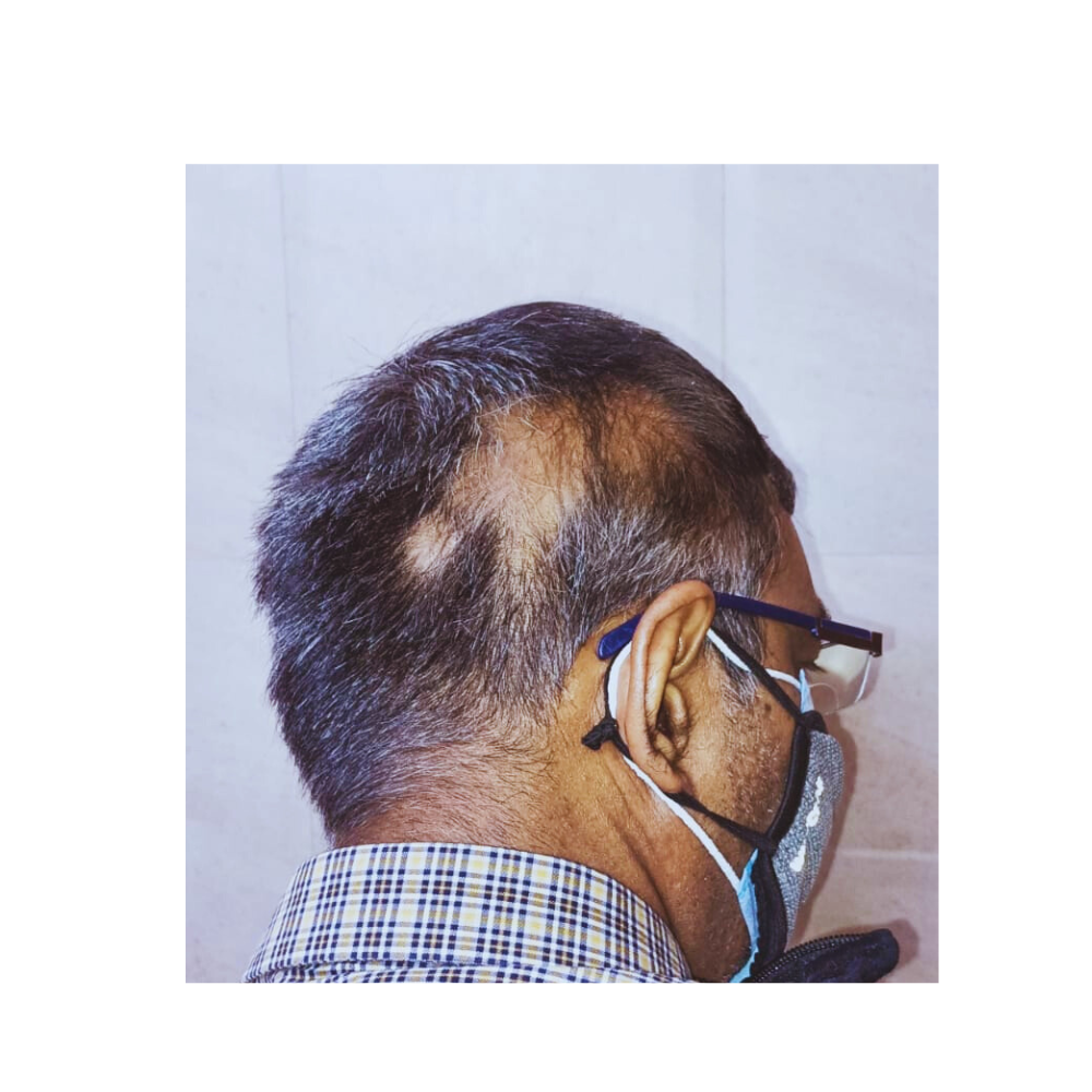 The best homeopathic treatment for hair loss