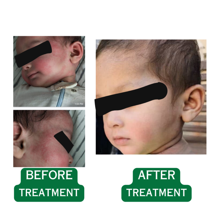 This image shows a child suffering from a skin disease