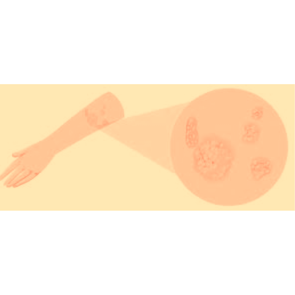 What happens in Psoriasis?