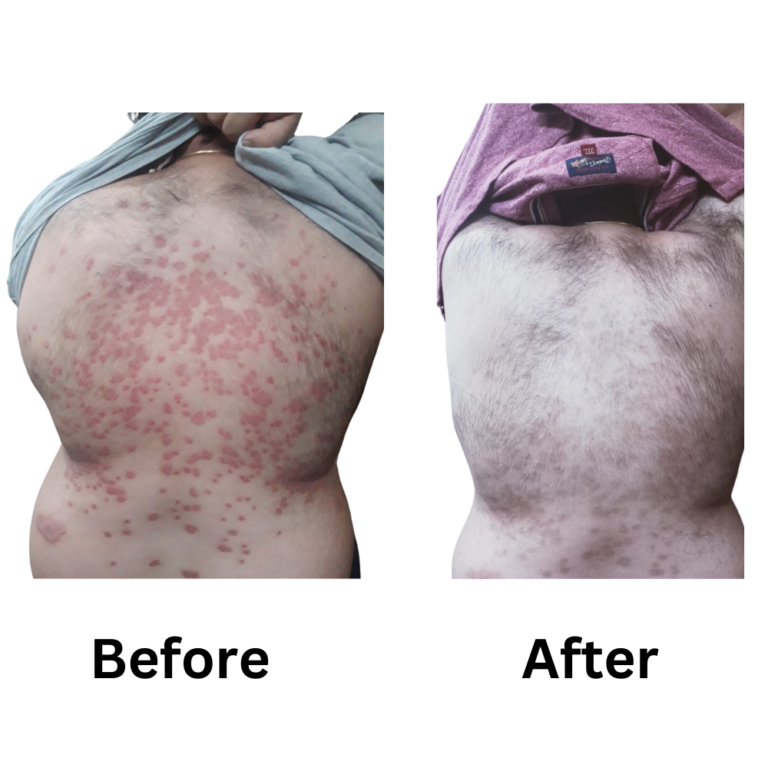 Best homeopathic treatment for psoriasis