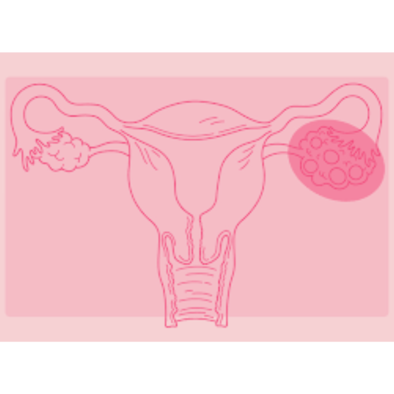 image showing the difference between a normal ovary and an abnorml ovary