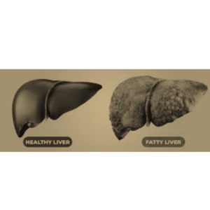 diseased liver which will become normal after the best homeopathic treatment for liver ailments