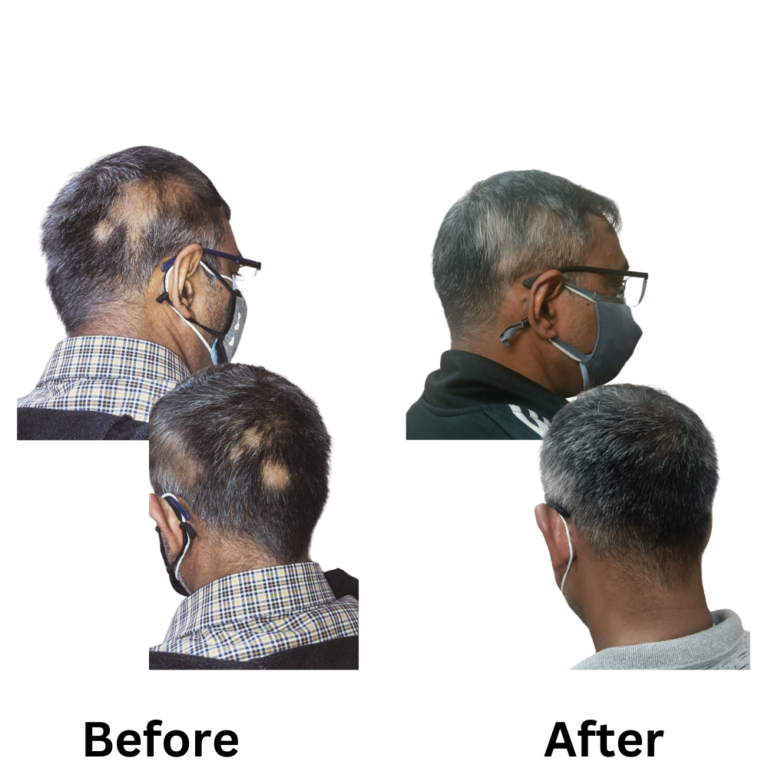 Results of Homeopathy portraying the we our the best homeopathic doctors for hair fall/hair loss