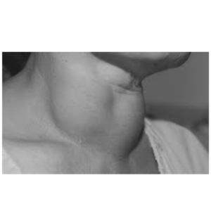 This image shows a person suffering from thyroid disease disease and will hence indicate a normal thyroid after the best homeopathic treatment for thyroid