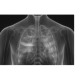 best homeopathic treatment for respiratory disorders