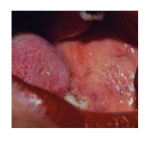 Image showing what is Lichen Planus