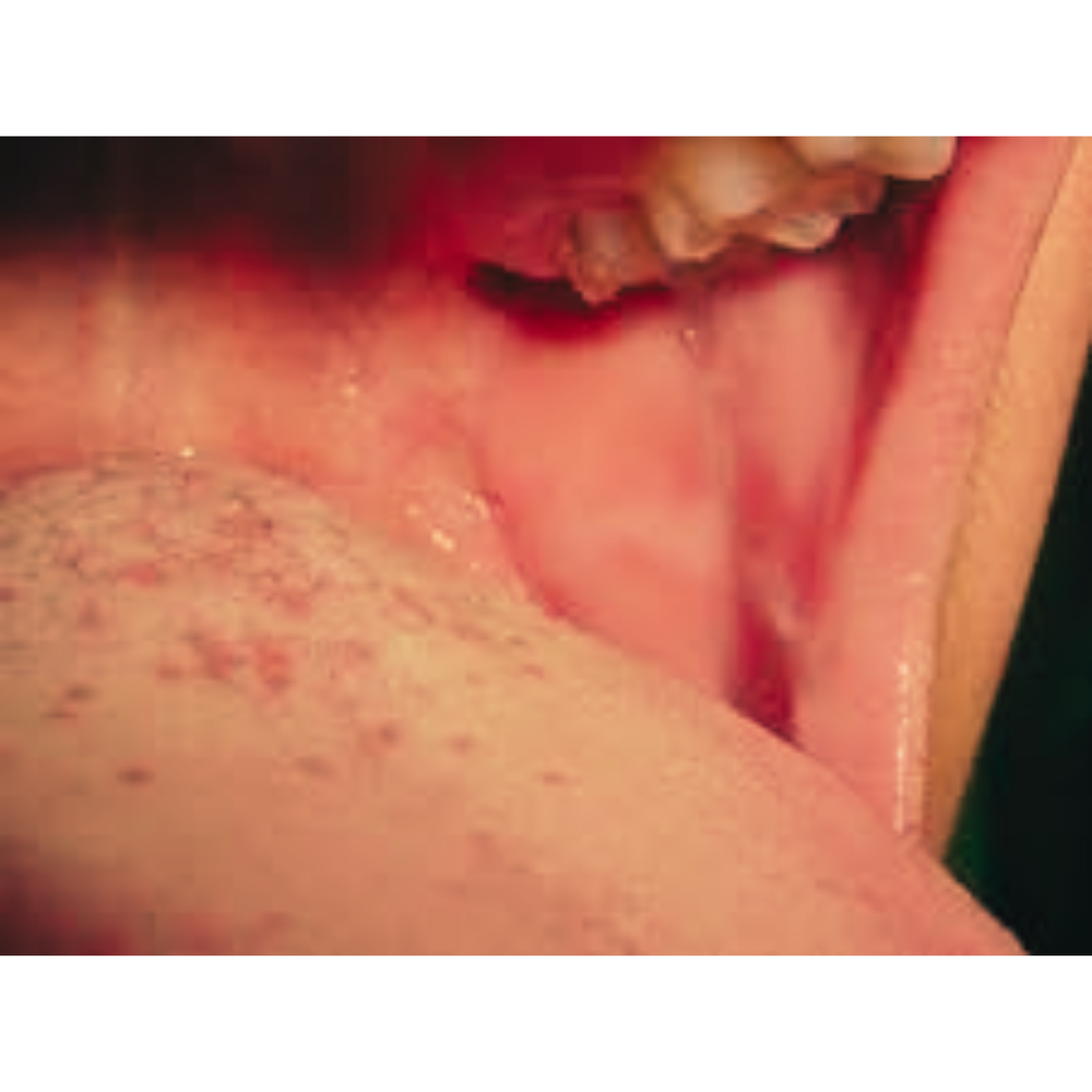 Causes of lichen planus