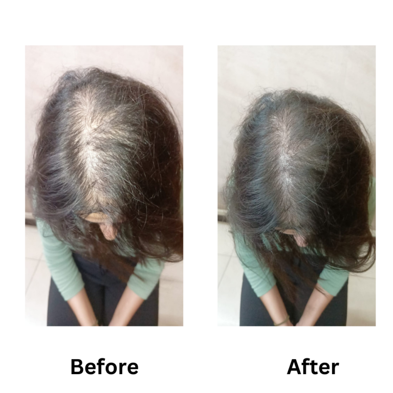 Results of Homeopathy portraying the we our the best homeopathic doctors for hair fall/hair loss