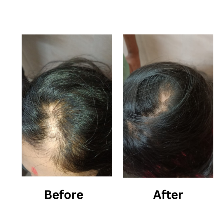 Results of Homeopathy portraying the we our the best homeopathic doctors for hair fall/hair loss